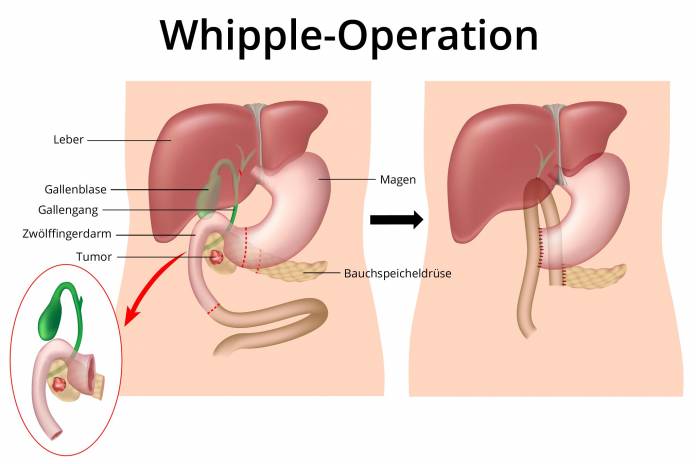 Whipple-Operation der Bauchspeicheldrüse