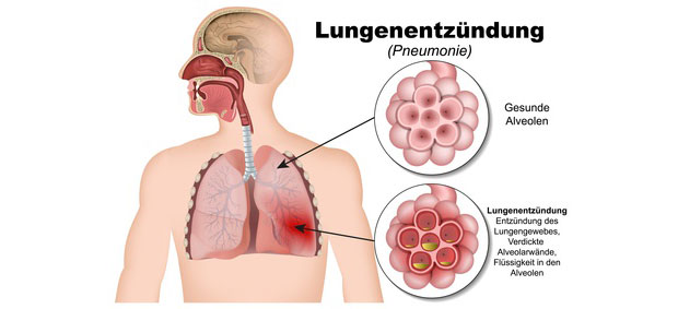 Lungenentzündung