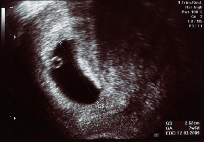 Ultraschallbilder Schwangerschaft