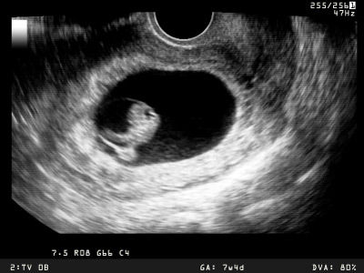 Ultraschall Baby Ultraschallbild personalisierbar Schwangerschaft Foto Bild