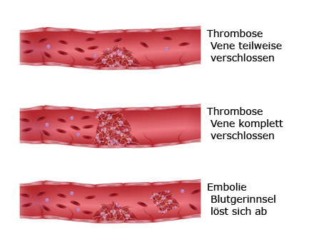 Unterschied Thrombose Embolie