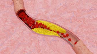 Wie wird eine Arteriosklerose behandelt?