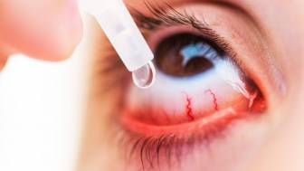Welche Augentropfen helfen bei einer Bindehautentzündung?