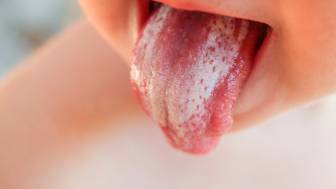 Candidiasis (Soor)