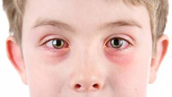 Wie wird ein Ekzem am Auge behandelt und was sind die Auslöser?