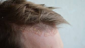Was sind die Ursachen für ein Ekzem an der Kopfhaut und wie wird es behandelt?