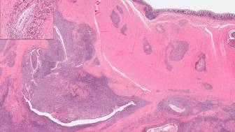 Endometriose