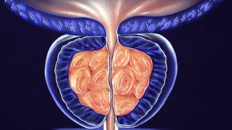 Gut. Prostatavergrößerung