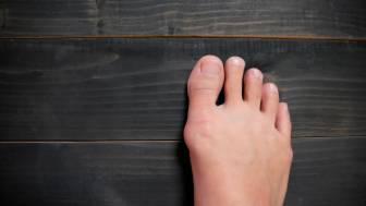 Hallux valgus