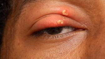 Herpes am Auge – wie kommt es dazu und wie wird behandelt?