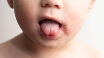 Herpes im Mund – wie kommt es dazu und wie wird behandelt?