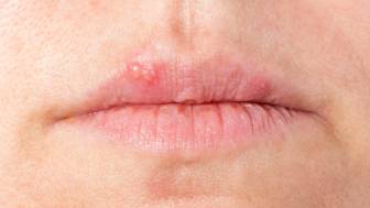 Herpes an den Lippen – wie kommt es dazu und wie wird behandelt?