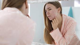 Was ist eine hormonelle Akne und wie wird sie behandelt?