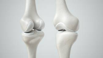 In welchen Fällen wird eine Knie-Arthroskopie bei einem Knorpelschaden durchgeführt ?