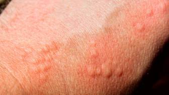 Kontaktdermatitis