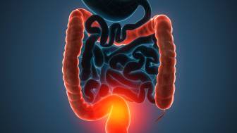 Wann ist ein künstlicher Darmausgang bei Morbus Crohn oder Colitis ulcerosa notwendig?