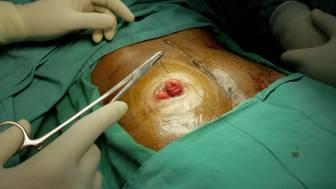 Wie lange dauert es, bis ein künstlicher Darmausgang zurückverlegt wird?