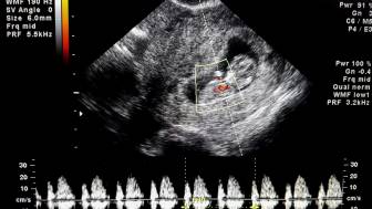 Wann kann ein Loch im Herz bei einem Ungeborenen festgestellt werden?