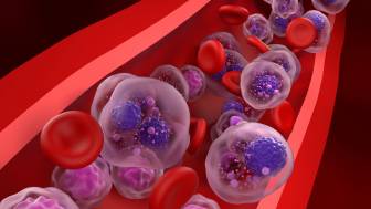 Blutkrebskrankheit: Multiples Myelom