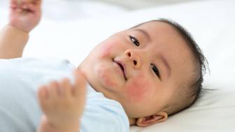 Nesselsucht bei Babys und Kindern – was sind die Ursachen und was kann man dagegen tun?
