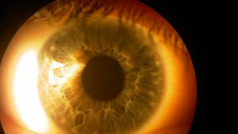 Was ist ein PEX-Glaukom?