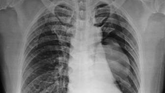 Wie kann man einen Pneumothorax verhindern?
