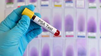 Was ist der PSA-Test und was sagt er bei Prostatakrebs aus?