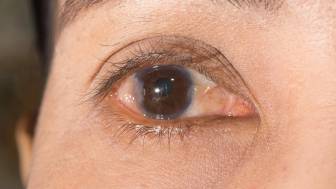 Pterygium