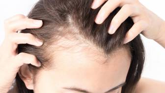 Inwiefern kann eine Schilddrüsenüberfunktion zu Haarausfall führen?