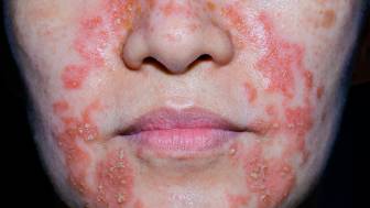 Was ist ein seborrhoisches Ekzem im Gesicht und wie wird es behandelt?