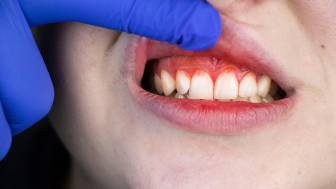 Zahnfleischentzündung (Gingivitis)