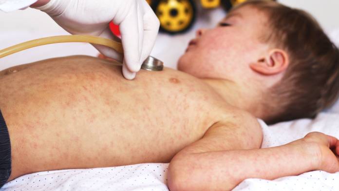 Masern: Sollte man Kinder impfen lassen?