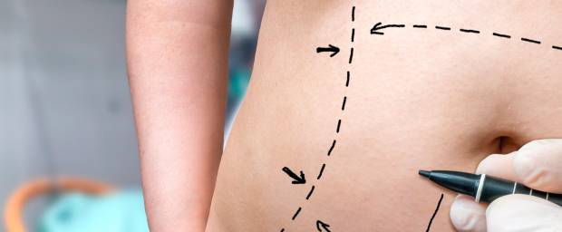 Bauchdeckenstraffung » Methoden, Risken, Behandlungserfolg