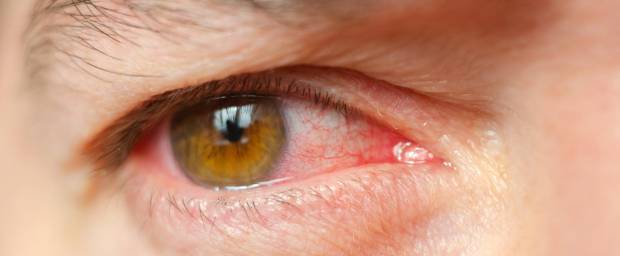 Männliches Auge mit Bindehautentzündung