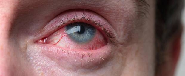 Augen Jucken Und Sind Rot