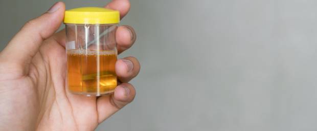 Wie urin wasser durchsichtig Farbskala: Was