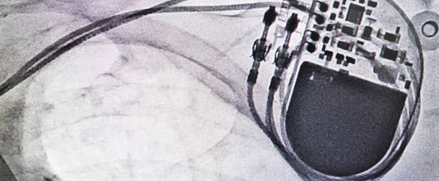 Herzschrittmacher forum