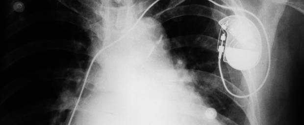 Röntgenbild zeigt Herzschrittmacher