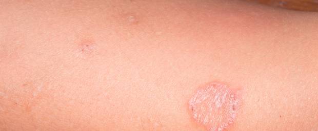 Impetigo Contagiosa Borkenflechte Grindflechte