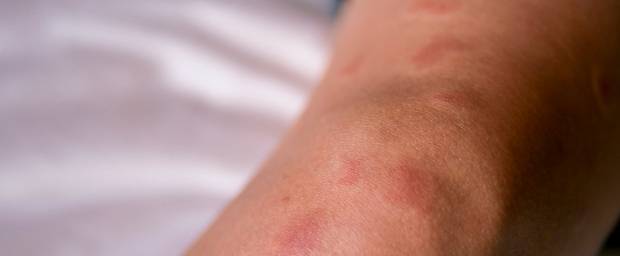 Allergische Hautreaktion vom Bein aufgrund einer Systemischen Lupus erythematodes (SLE)