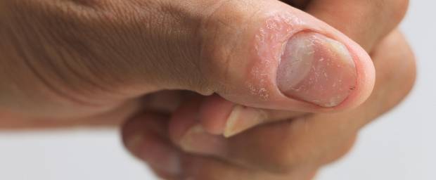 Fingernagel, der von Psoriasis betroffen ist