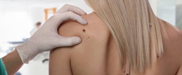 Dermatologe untersucht Leberfleck auf dem Rücken einer jungen Frau