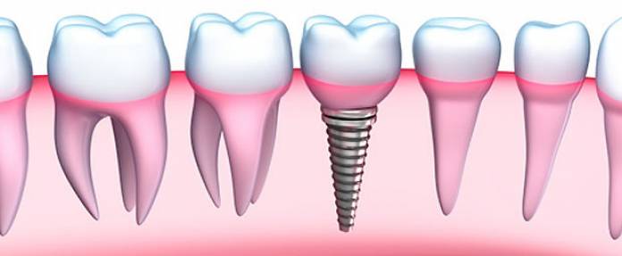 Zahn-Implantate für ein dauerhaftes, schönes Lächeln