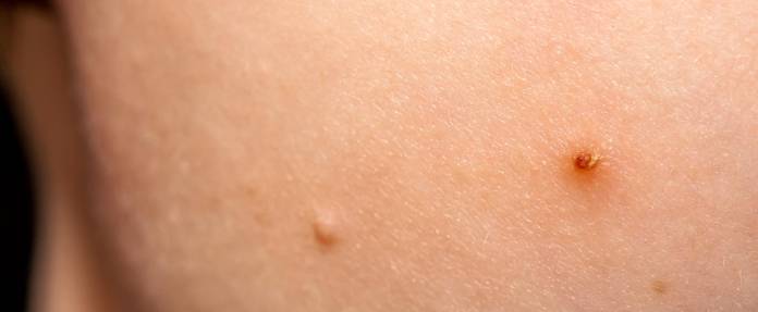 Dellwarzen bei Kindern – wie lassen sie sich feststellen und behandeln?