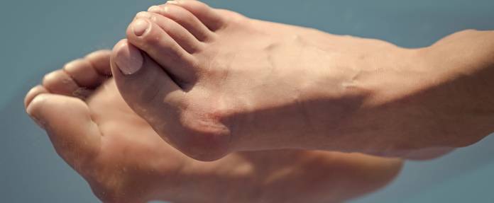 Wie funktioniert die Hallux-valgus-OP und welche Verfahren gibt es?