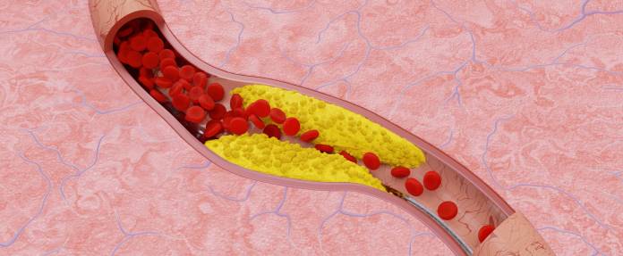 Verengte Arterie bei einer Arteriosklerose