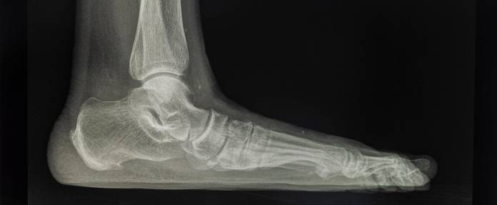 Röntgenbild eines Plattfußes