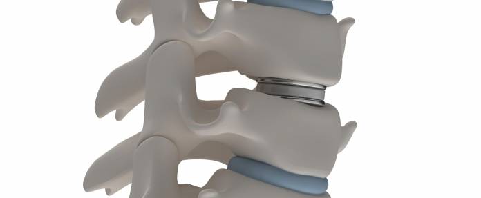 Bandscheibenprothese in 3D-Abbildung