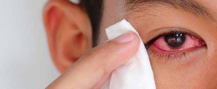 Mann mit Bindehautentzündung wischt mit Tuch über das Auge