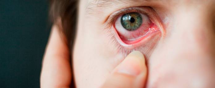 Bindehautentzündung am Auge